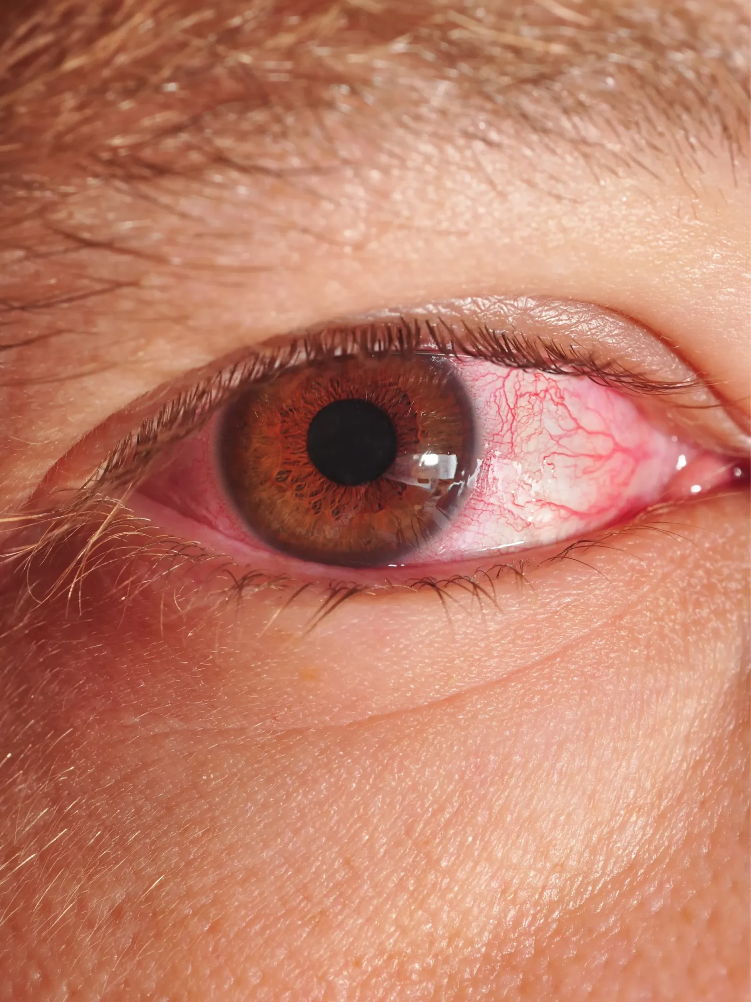 Alergia ocular: Conjuntivitis Alérgica